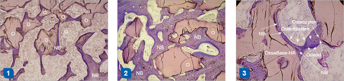 Ausgezeichnete osteokonduktive Eigenschaften vom Knochenersatzmaterial OssaBase-HA. 1. Bildung des neuen Knochens (3 Monate nach Implantation). 2. Einwachsen des neuen Knochens in intergranuläre Räume und Makroporen von OssaBase-HA (6 Monate nach Implantation). 3. Detail der Osteokonduktion vom Knochenregenerationsmaterial OssaBase-HA. 