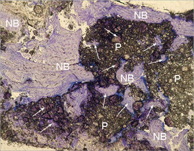 7 Monate nach der Sinusbodenelevation: Der neu gebildete Knochen (NB) ist im direkten Kontakt mit Knochenersatzmaterial PORESORB-TCP. Die Pfeile zeigen den neu gebildeten Knochen in den Poren des Knochenersatzmaterials. (Dr. M. D. Cevallos Lecaro, Ph.D.)