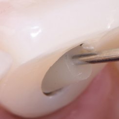 SilverPlug – antibakterielles Verschlussmaterial für den Implantatschraubenkanal