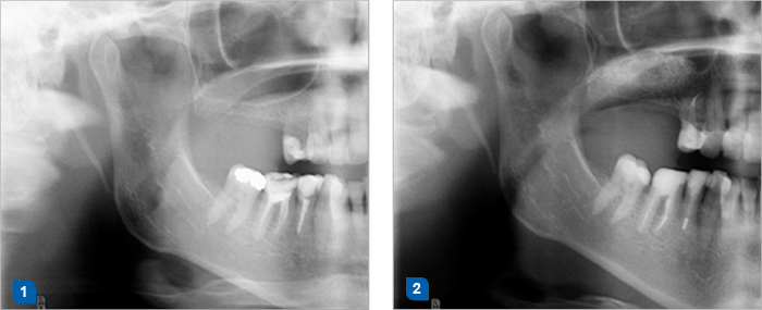 1. Klinische Situation vor Sinusbodenelevation.  2. Knochenersatzmaterial PORESORB-TCP wurde mit dem eigenen Knochen gemischt. Klinische Situation sechs Monate nach Sinusbodenelevation und zugleich noch vor der Implantatinsertion.